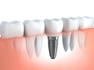 affordable dental implants