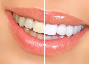 teeth whitening specialists